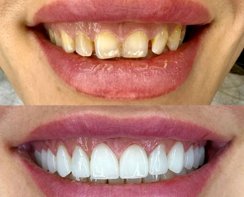 Diş Before After-08 copy
