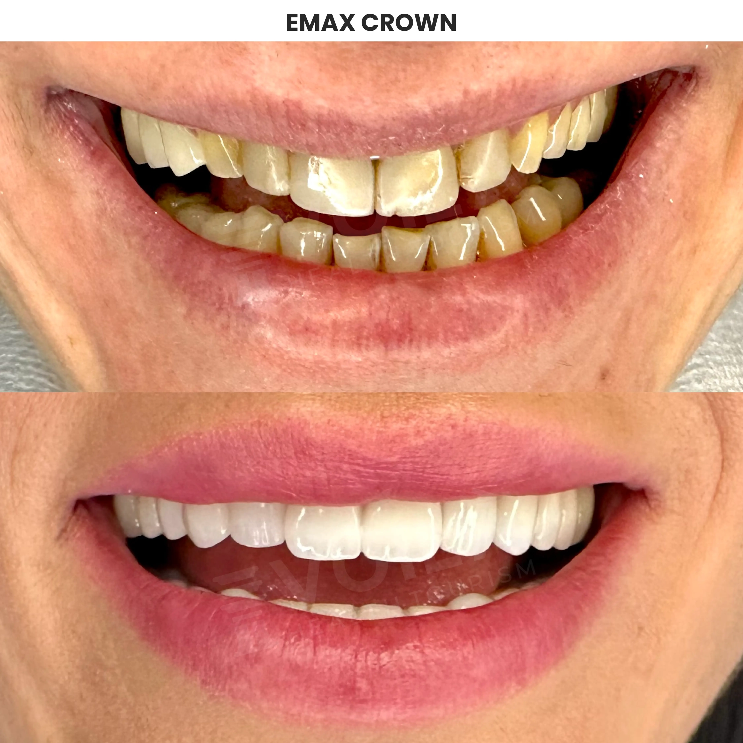Diş Before After-15 copy