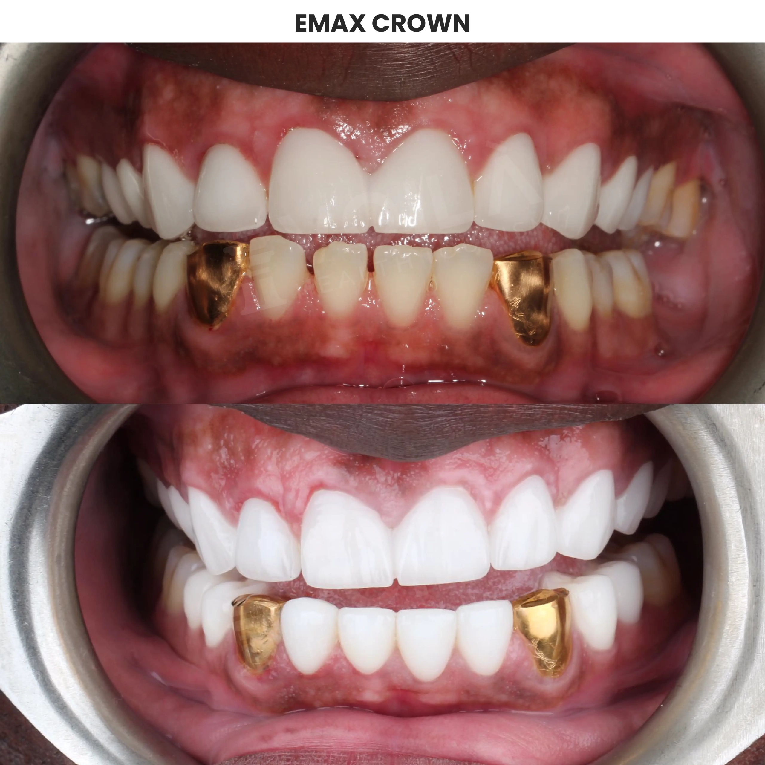 Diş Before After-21 copy