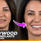 Hollywood smile and implants in Turkey treatment at VoilaDent Istanbul