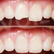 Dental Bonding in İstanbul Voiladent Dental Clinic
