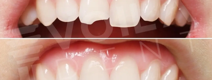 Dental Bonding in İstanbul Voiladent Dental Clinic