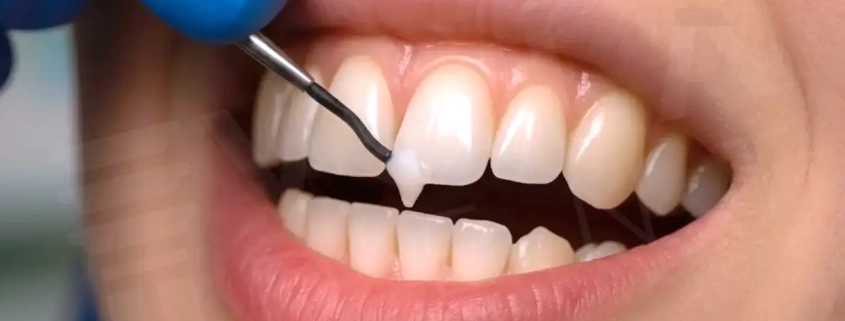 Dental Bonding: The 2-Hour Smile Fix Everyone Is Talking About