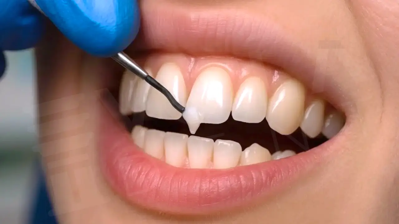 dental bonding voiladent Dental Bonding: The 2-Hour Smile Fix Everyone Is Talking About