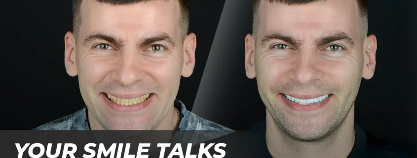 why people notice your teeth